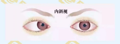 什么是調(diào)節(jié)性內(nèi)斜視？