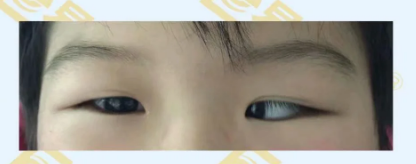 什么是先天性內(nèi)斜視？