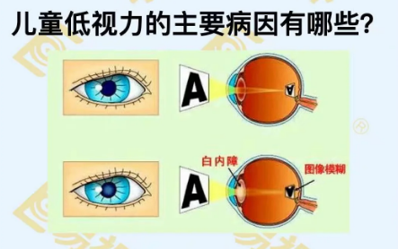 兒童低視力主要病因有哪些？