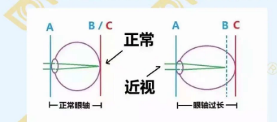 哪個(gè)年齡近視度數(shù)最容易增長(zhǎng)？