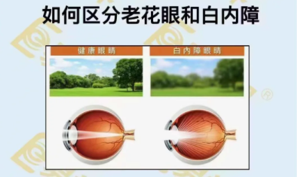 如何區(qū)分老花眼和白內(nèi)障？