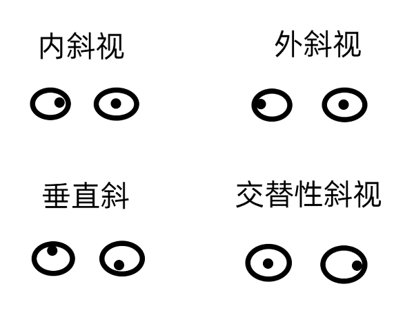 斜視早期的癥狀有哪些？